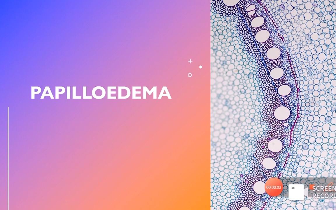 Papilledema | Optic Disc Swelling  视盘水肿 | 视乳头水肿哔哩哔哩bilibili