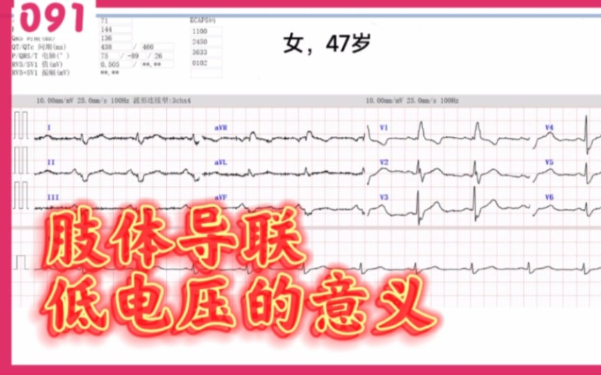 肢体导联低电压的意义哔哩哔哩bilibili