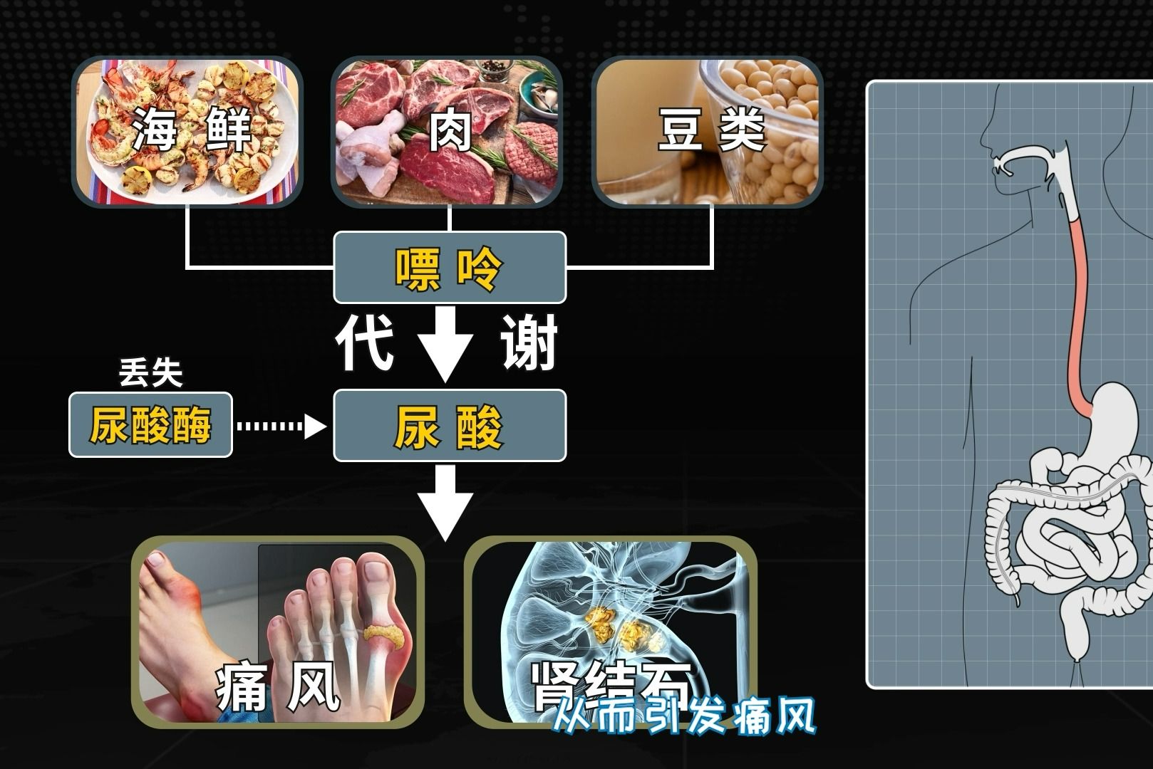 抗癌研究的意外发现——别嘌呤醇治痛风哔哩哔哩bilibili