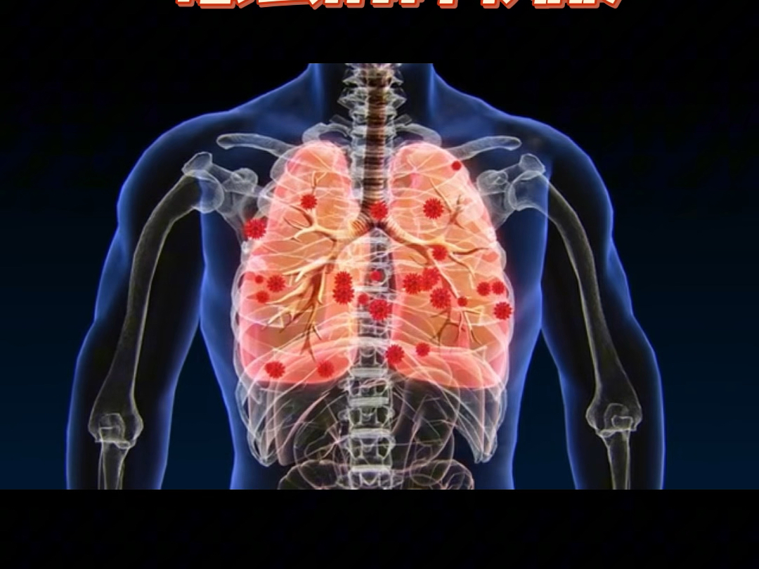 胸腔积液严重吗?发现积液能活多久?该怎么治疗呢