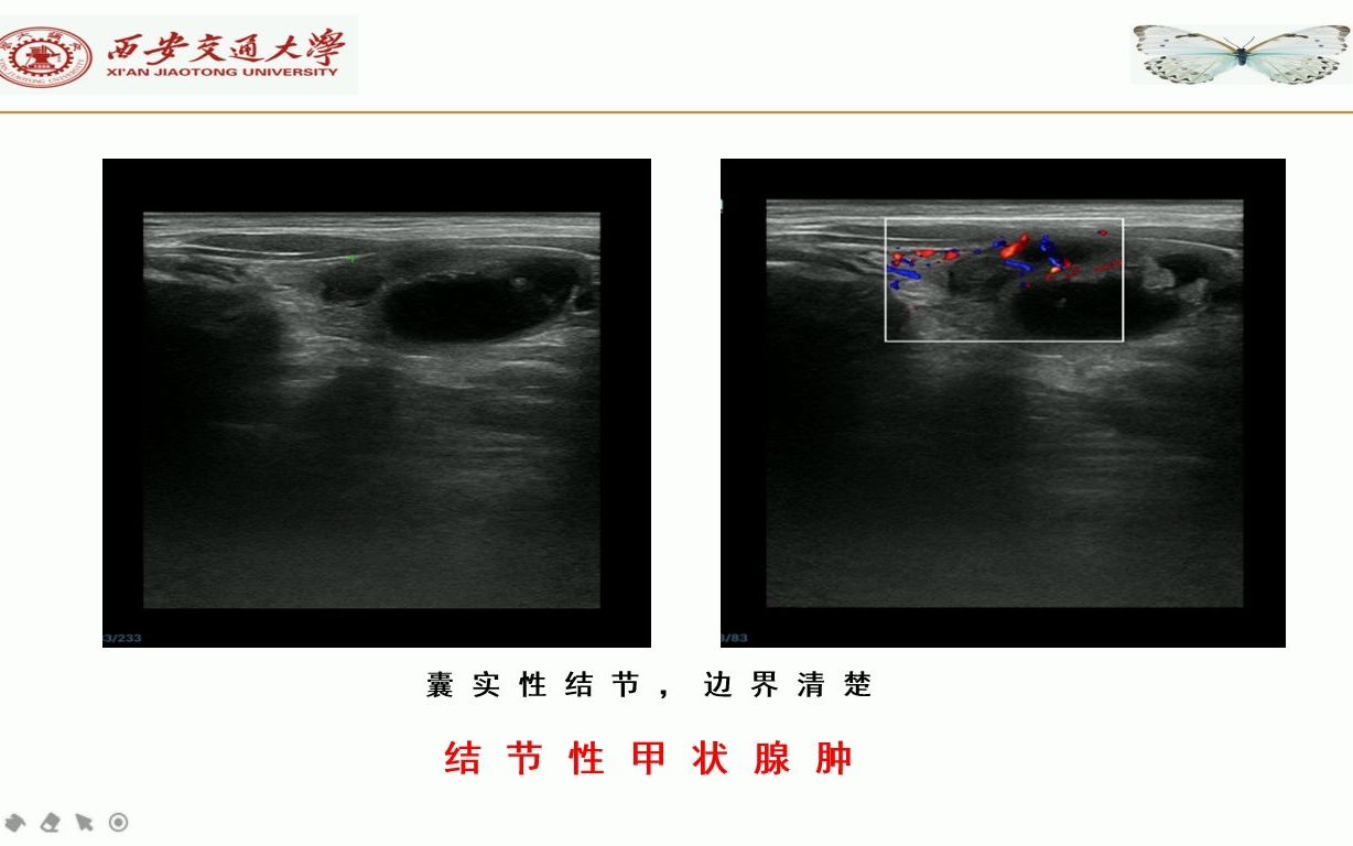 [图]《甲状腺结节的超声诊断》