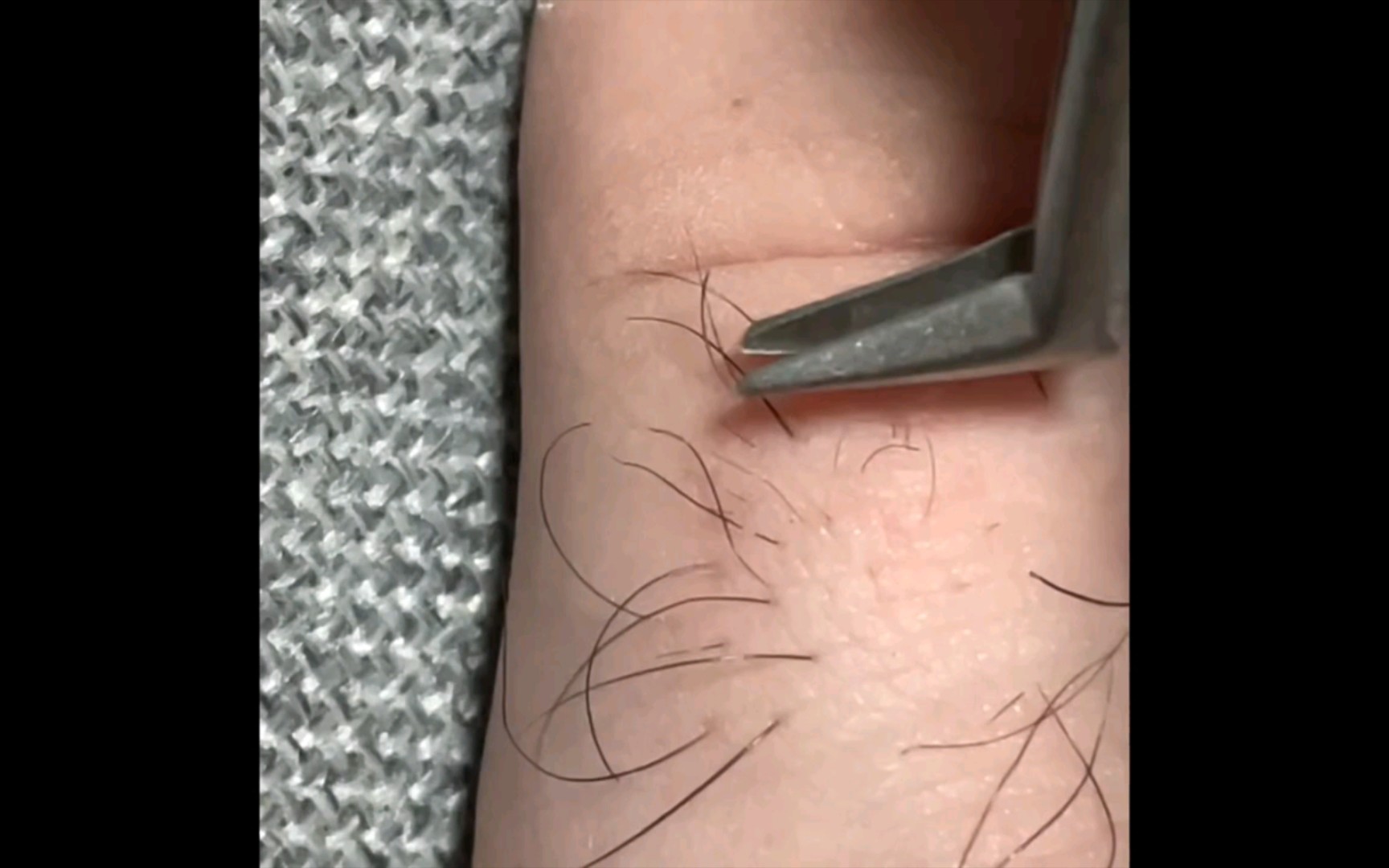 拔脚趾头上的毛