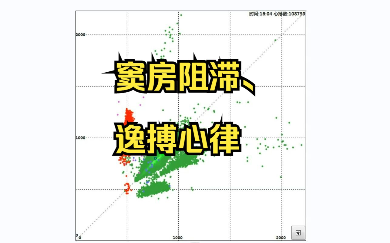 窦房阻滞和逸搏心律哔哩哔哩bilibili