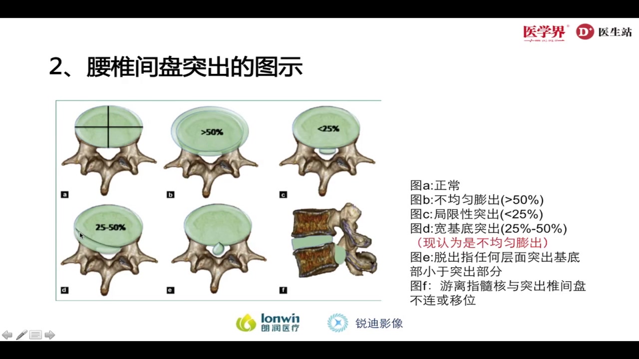 腰椎间盘突出神经根压迫CTMR解析哔哩哔哩bilibili