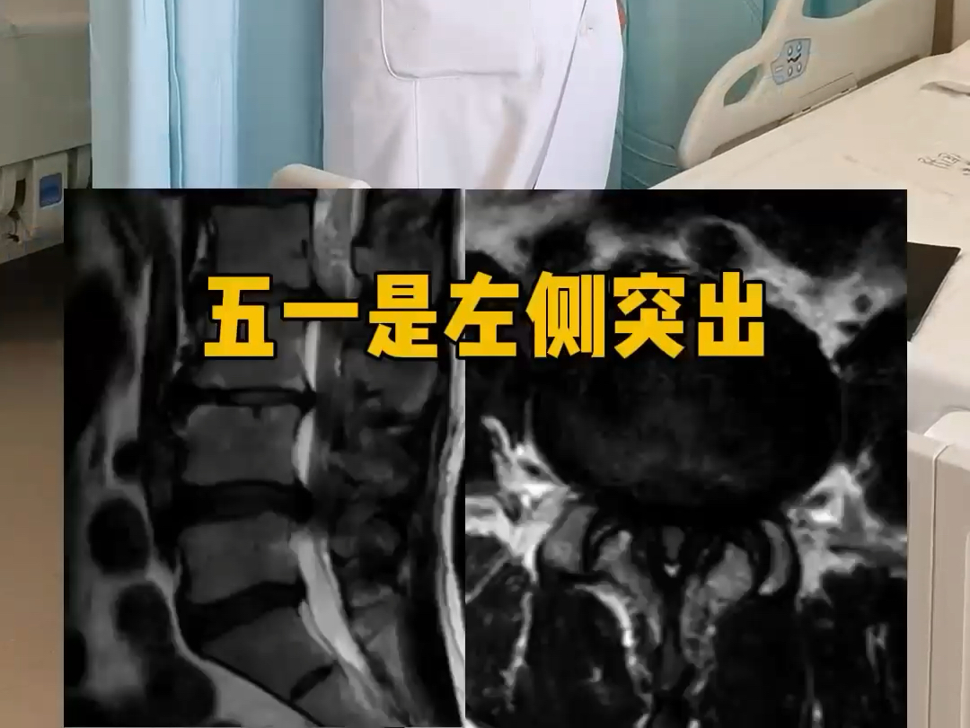 腰椎管狭窄