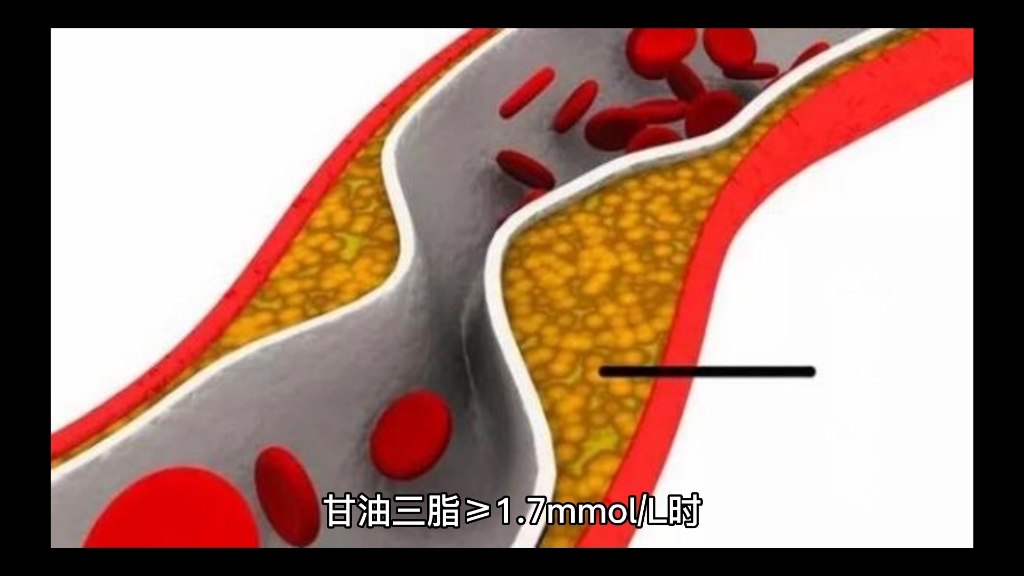 “甘油三酯”超过这个数值,容易心梗?哔哩哔哩bilibili