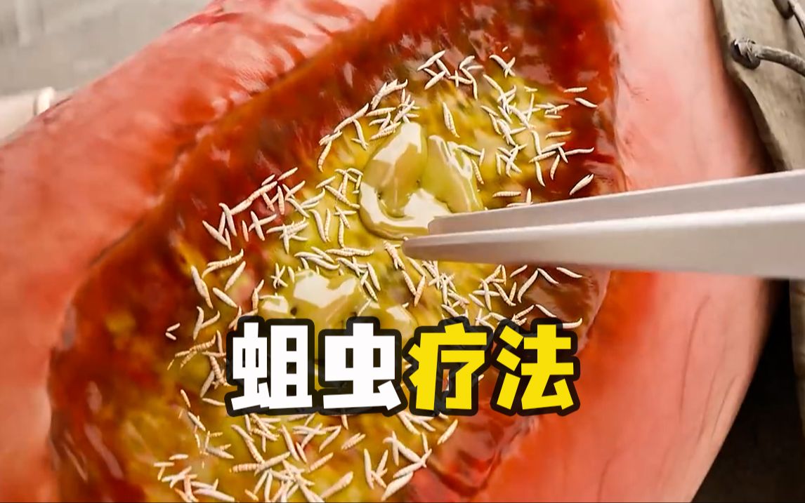 蛆虫疗法,用蛆虫吃自己的肉!