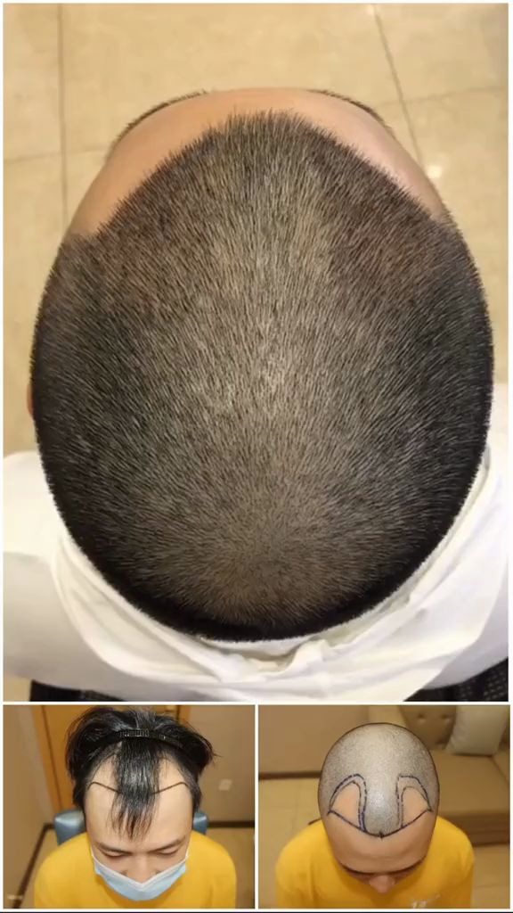 男士m型发际线,发际线调整,植发术后7天效果