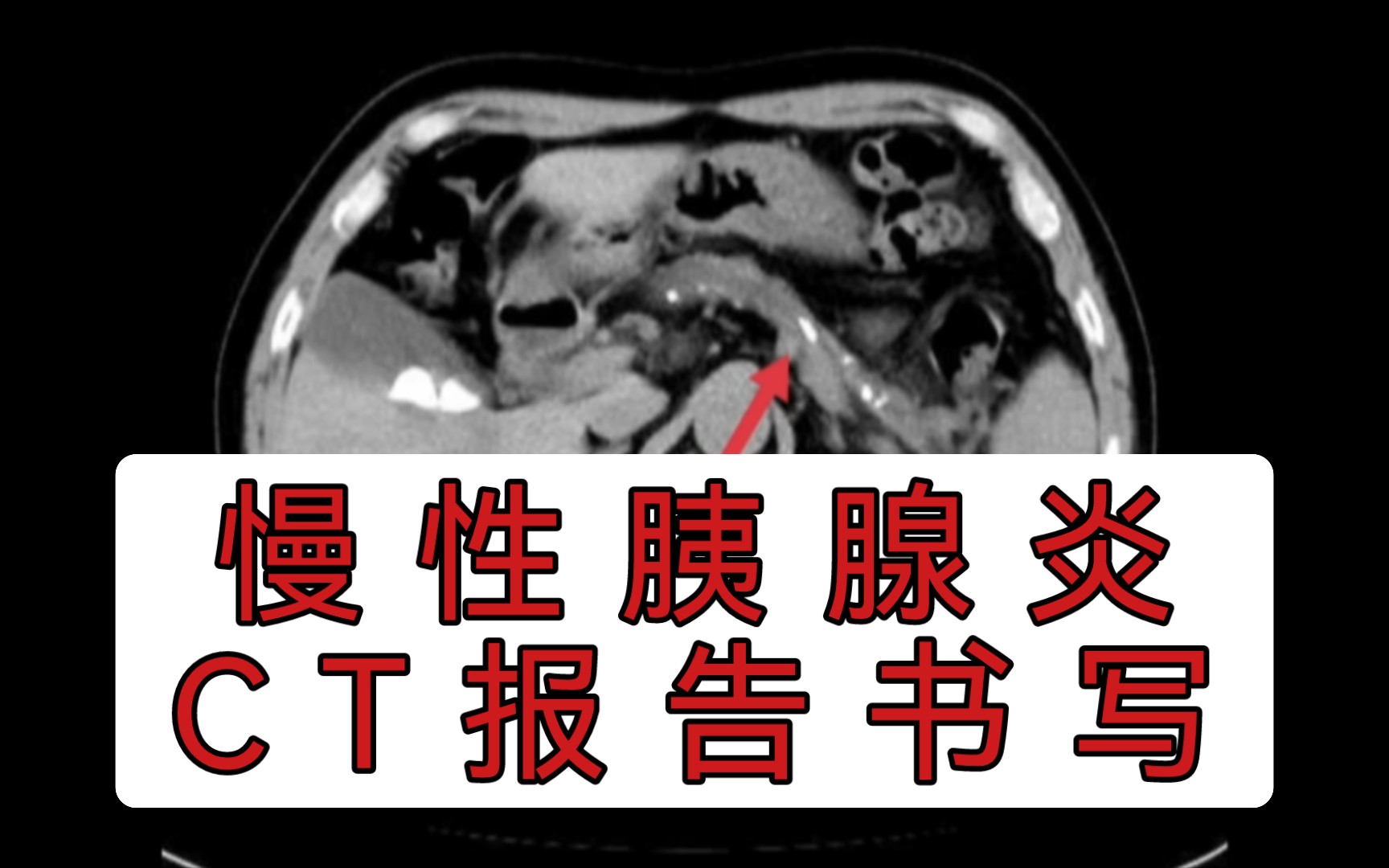 影像读片 慢性胰腺炎