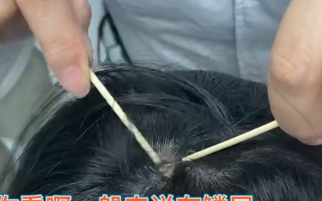 女子头皮瘙痒掉屑，到诊室医生拿棉签一拨，发现是银屑病