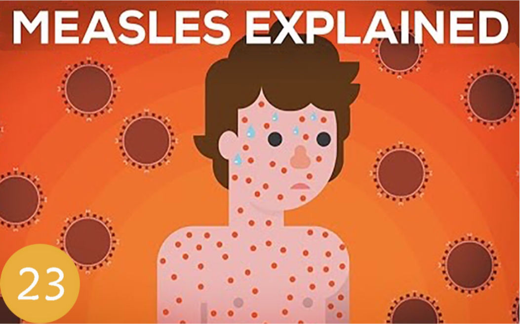 [图]【Kurz】第23期：什么是麻疹病毒？我们应该接种疫苗吗？Measles Explained - Vaccinate or Not？