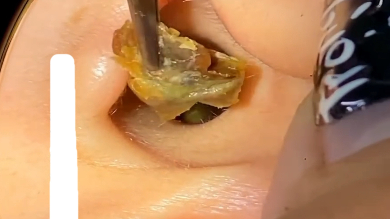 一辈子没掏过耳朵,里面塞了好大一坨狠货