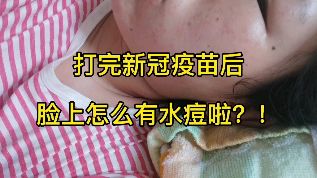 打完新冠疫苗后脸上起水痘了怎么办啊