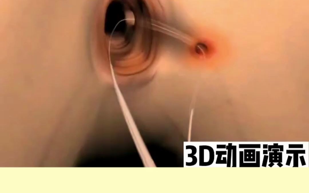 3D动画演示肛瘘栓的技术哔哩哔哩bilibili