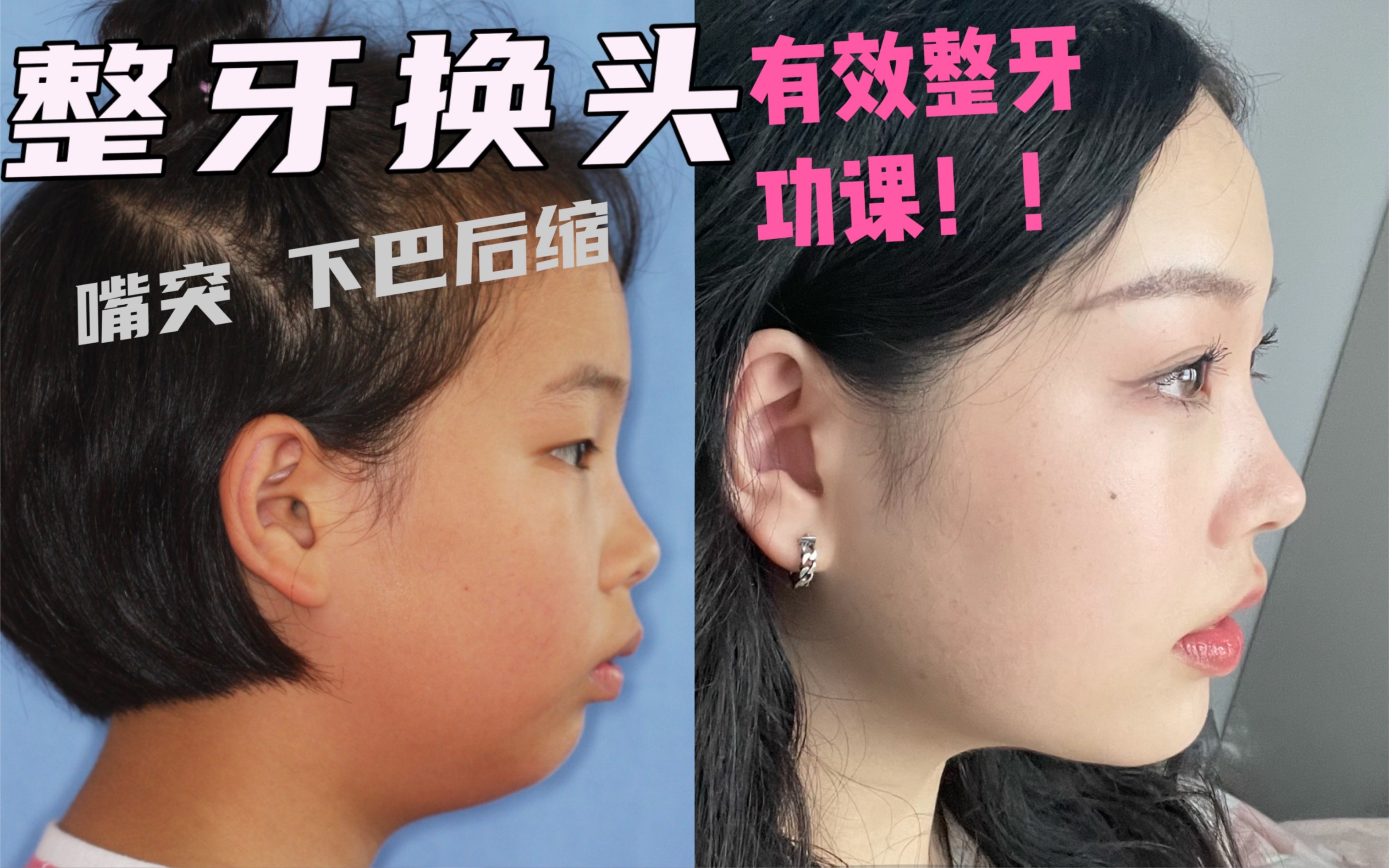 严重嘴突下巴后缩整牙经历分享!!从小夫变成仙女!哔哩哔哩bilibili