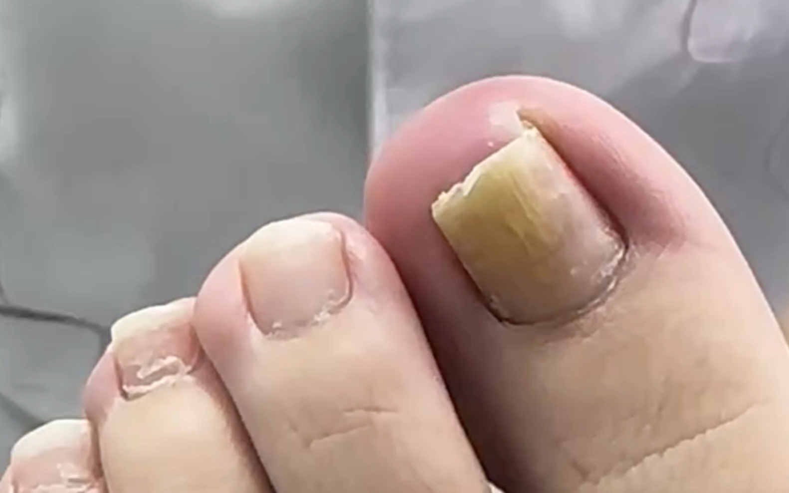 甲沟炎化脓 B站