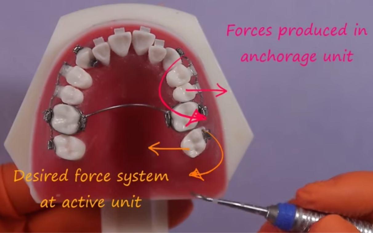 [图]正畸 7号牙远中扭转 passive loop 支抗单元