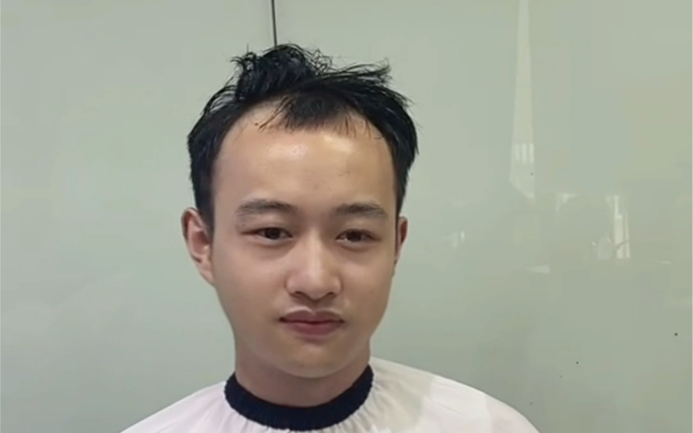 专业改造m型发际线二十年,专业的