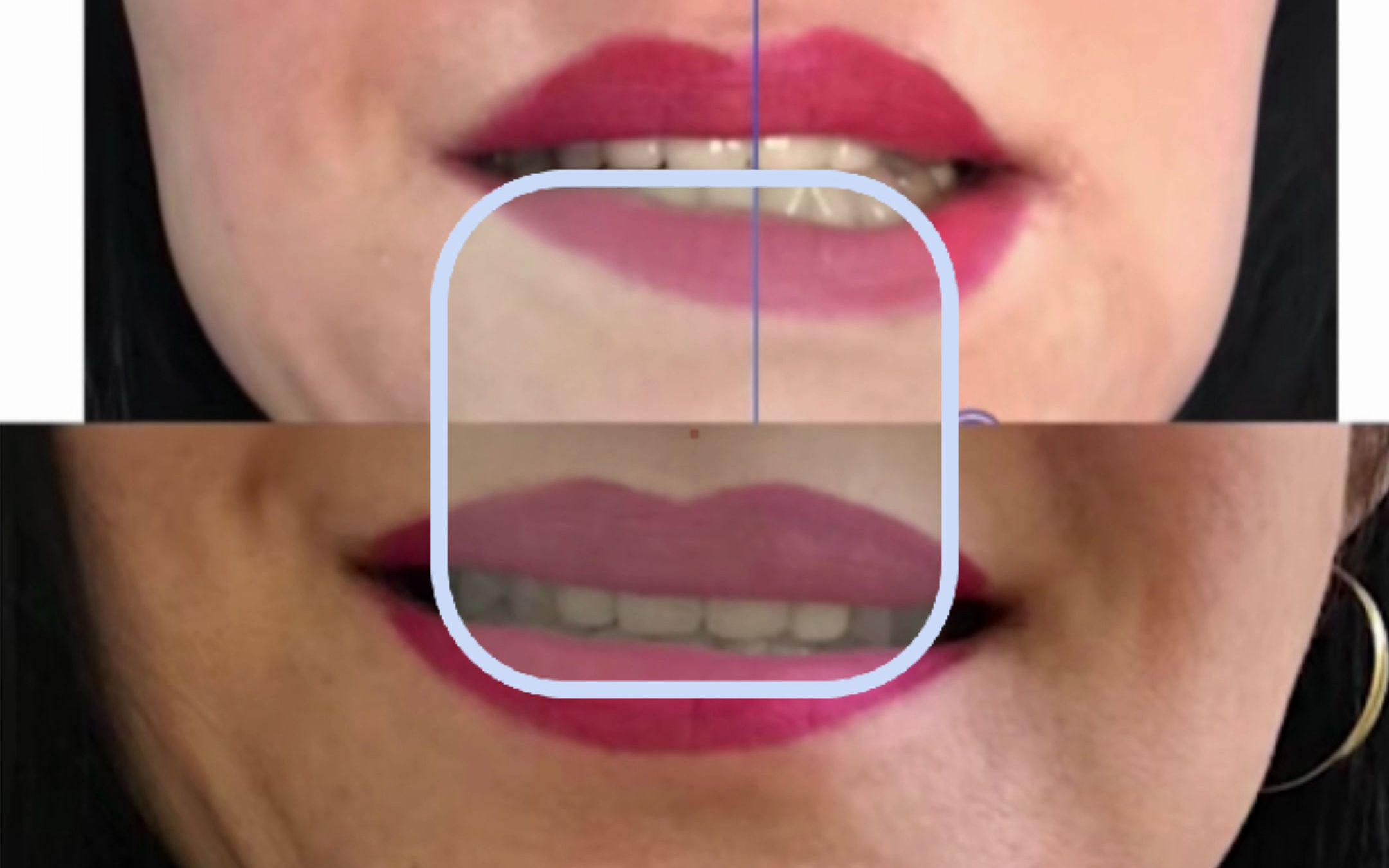 打完瘦脸针耐克嘴 怎么办?_哔哩哔哩_bilibili