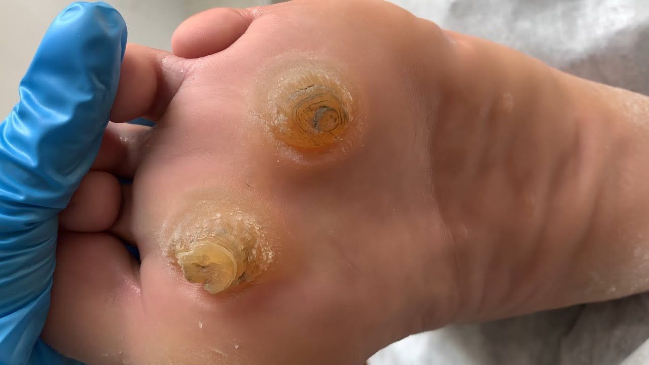 完整版本!不可思议的足底老茧/像两只眼睛