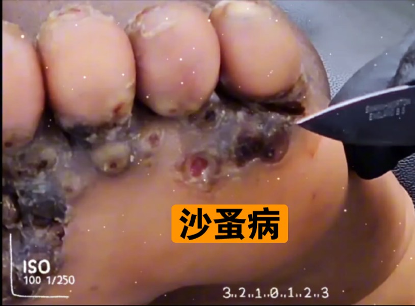 沙蚤病清理,解压