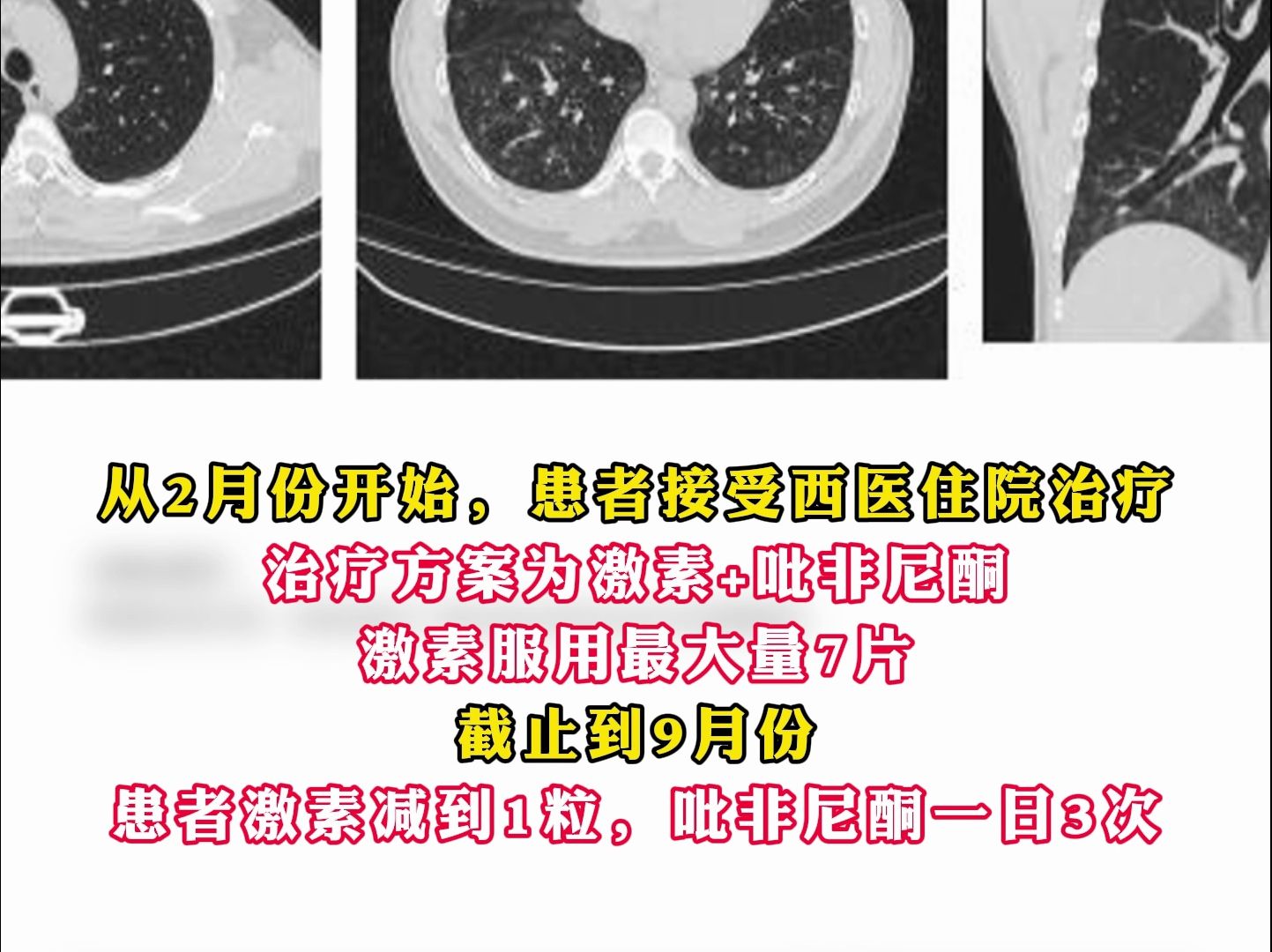 间质性肺炎伴纤维化,患者真实就诊全程