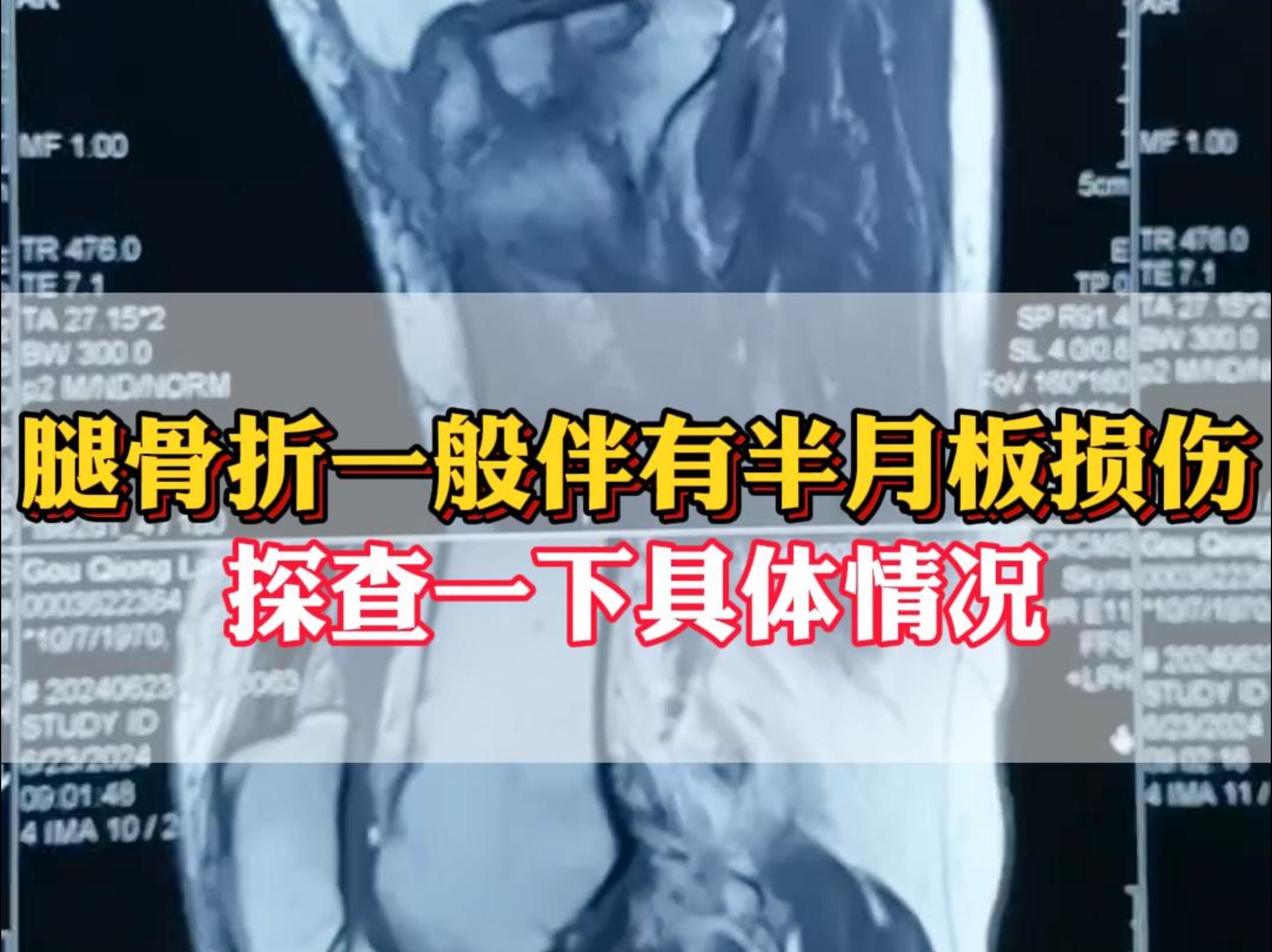 骨折可能伴有半月板损伤,一定要关节镜探查一下具体情况