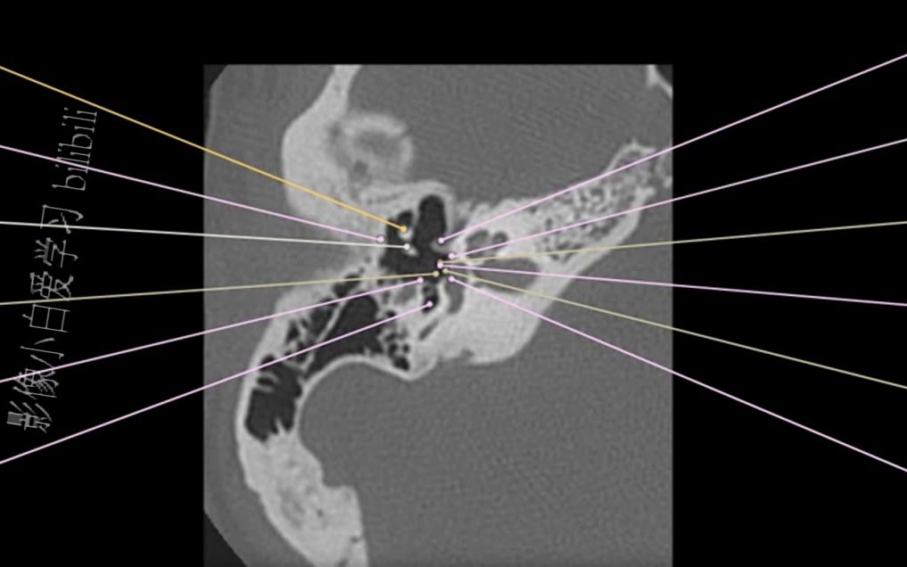 3.头颈CT解剖图谱中耳CT解剖哔哩哔哩bilibili