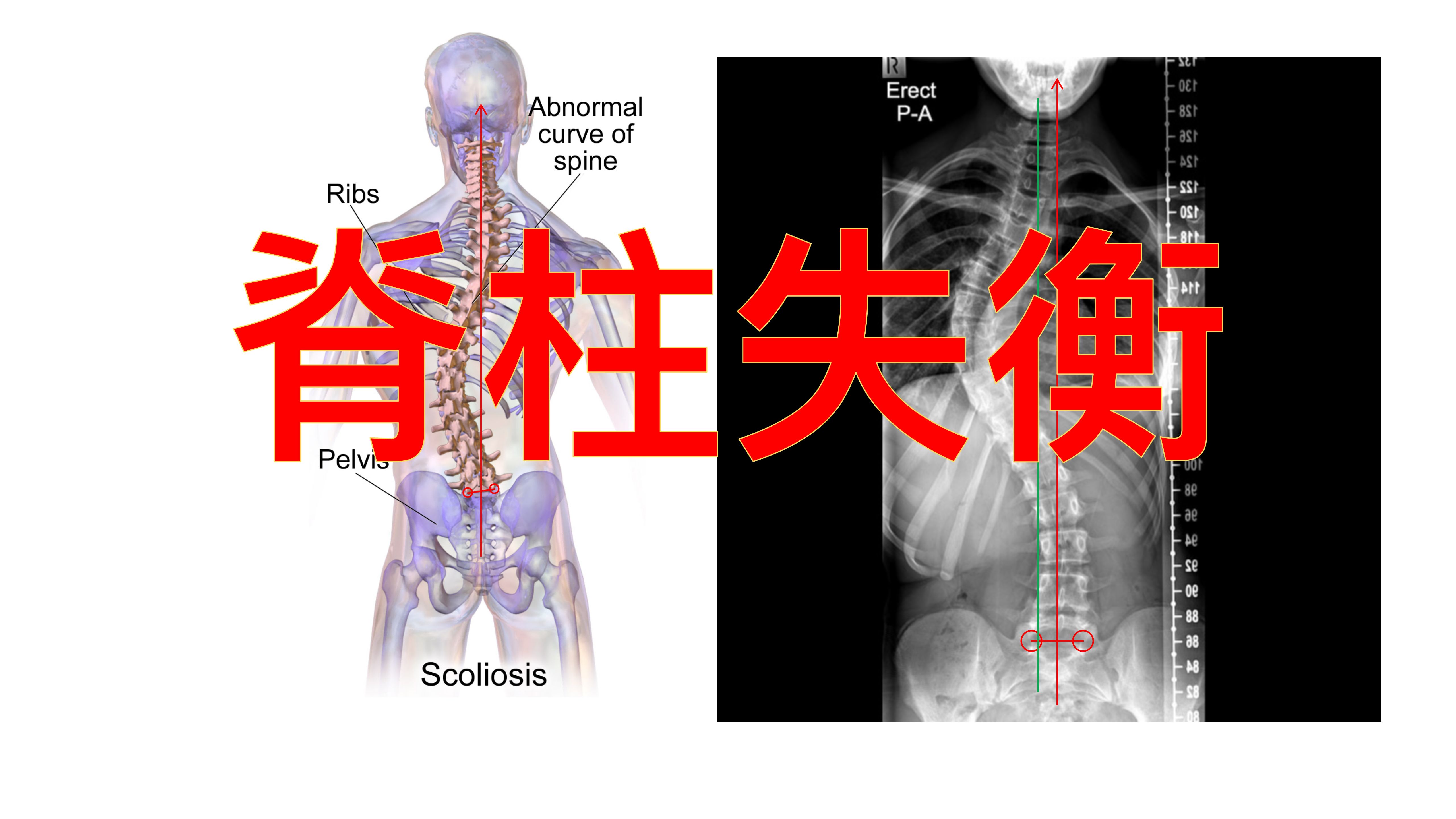 如何通过片子判断脊柱是否在冠状面上出现失衡?哔哩哔哩bilibili