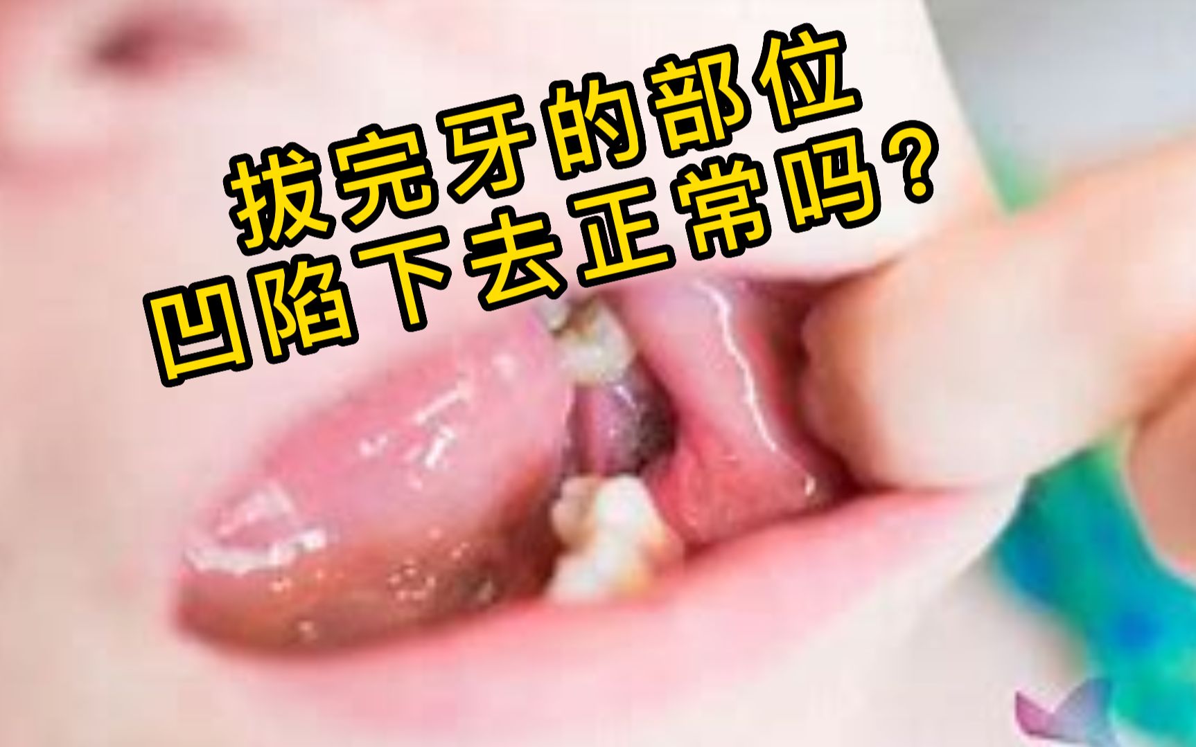 拔完牙的部位凹陷下去正常吗?哔哩哔哩bilibili