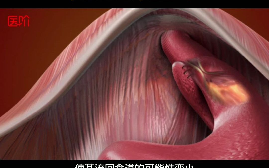 3d医学动画:胃底折叠术_哔哩哔哩_bilibili