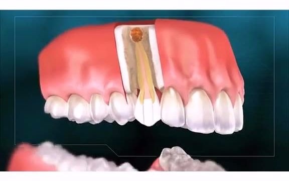 [图]根尖周炎，长了根尖囊肿怎么办？一起来看看！「大连齿医生口腔修复中心」「大连口腔医院」
