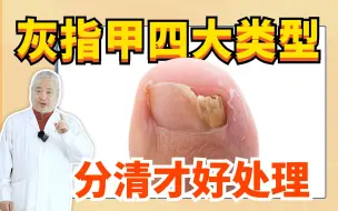 下载视频: 【皮肤科教授】上联：得了灰指甲，下联：...，看完这个视频你就知道灰指甲怎么处理了