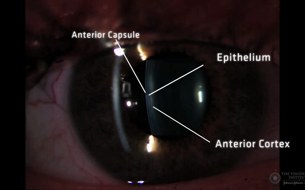 [图]【中英双字】【裂隙灯晶状体检查】Slit Lamp Techniques Optical Section of Crystalline Lens