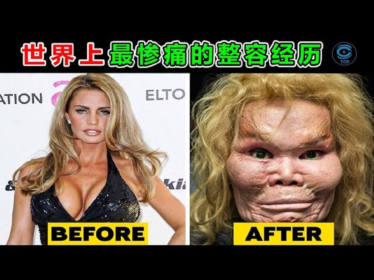 [图]一朝梦碎？美艳女星变丑女无敌，整容成瘾的代价你能承受吗？8个有着失败整容经历的人#最大 #最小 #世界之最 #top #动物 #排名 #冷知识 #整容 #明星