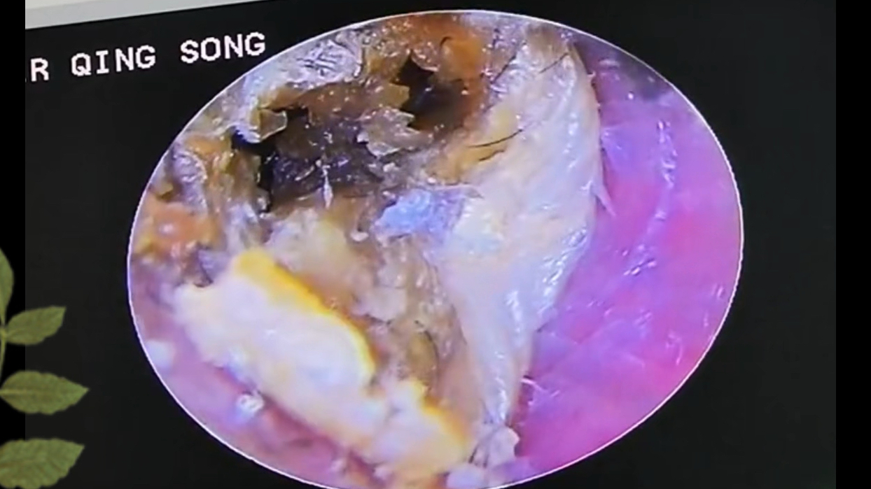 一辈子没掏过耳朵、整个耳道都塞满了 挖出好多狠货哔哩哔哩bilibili