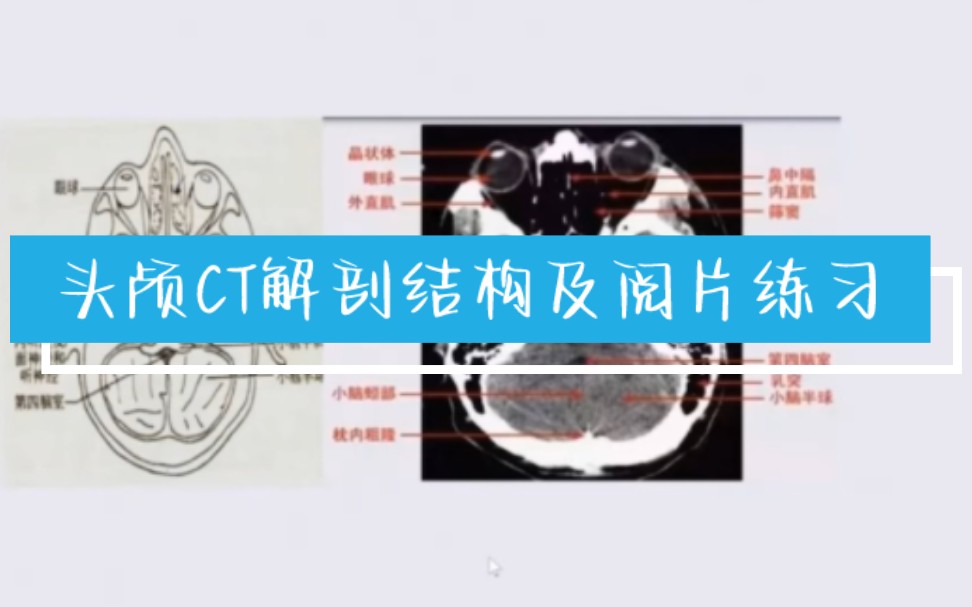 CT阅片头颅解剖结构及阅片练习哔哩哔哩bilibili