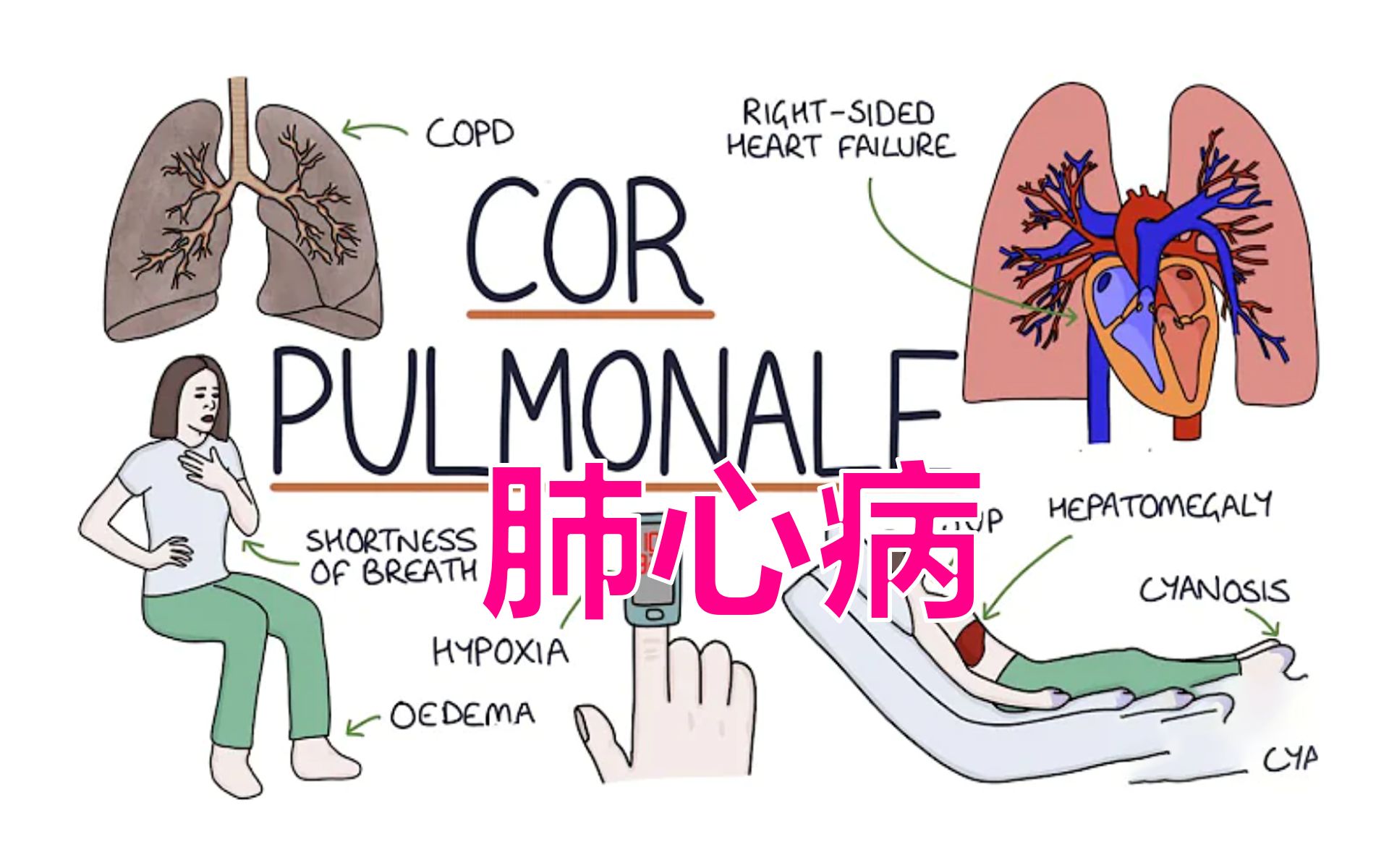 肺源性心脏病发病机制 肺心病原因是什么?