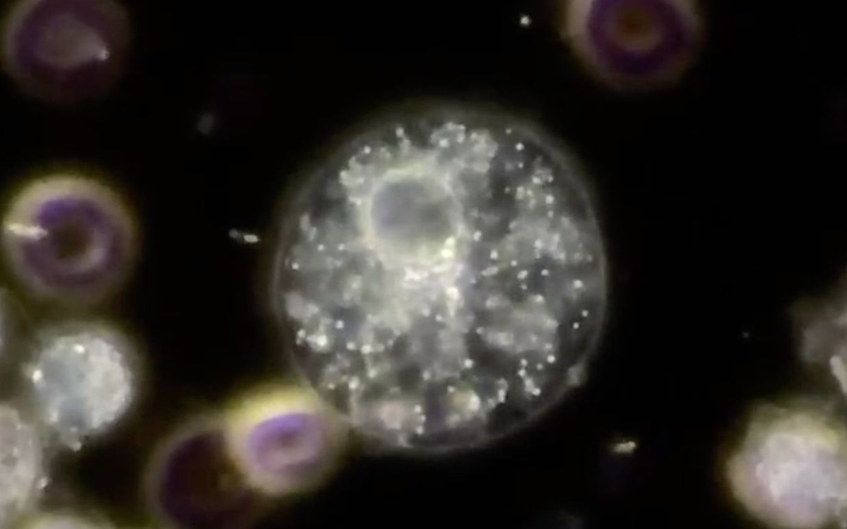 显微镜下的尿液闪光细胞