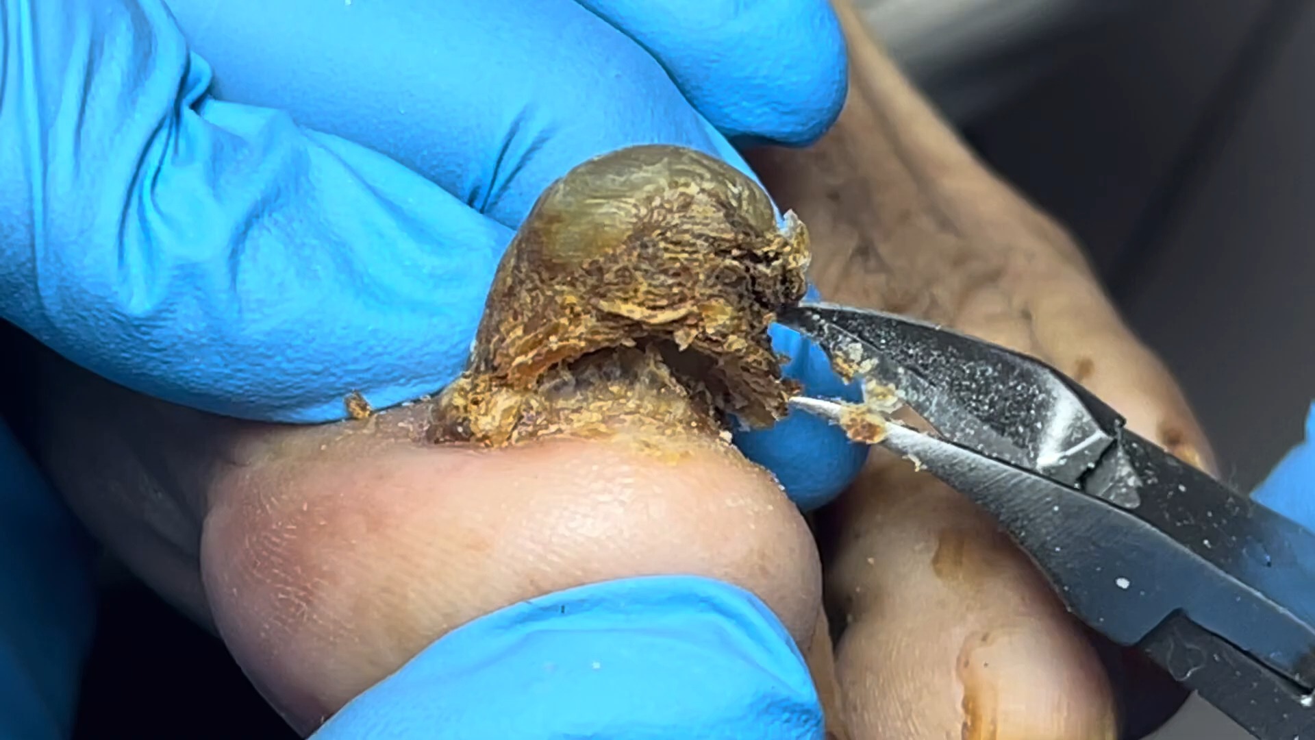 脚趾甲都叠起了