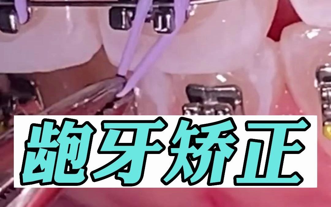 龅牙矫正戴上牙套的过程哔哩哔哩bilibili