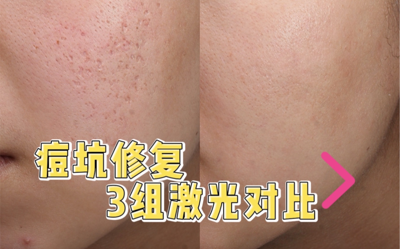 厢车,冰锥痘坑,3组点阵激光后的变化