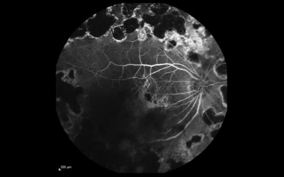 【荧光素血管造影】【FFA】【脉络膜视网膜吻合/新生血管】RealTime Fluorescein Angiography哔哩哔哩bilibili