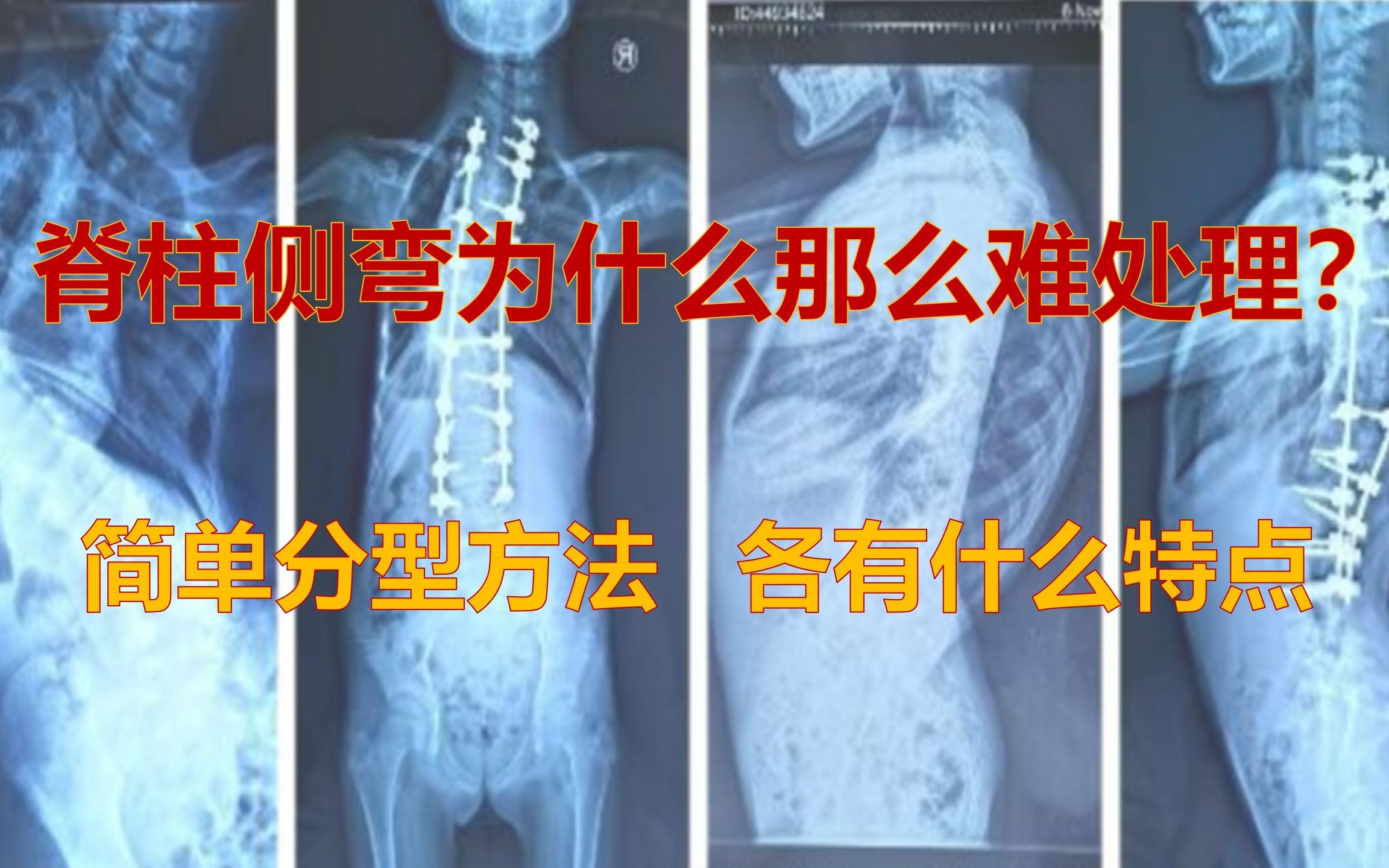 [图]脊柱侧弯的重要分型及其特点