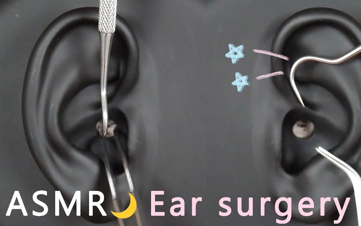 【Olive】1小时镊子+探针耳朵手术 Ear surgery 1 Hour No Talking哔哩哔哩bilibili