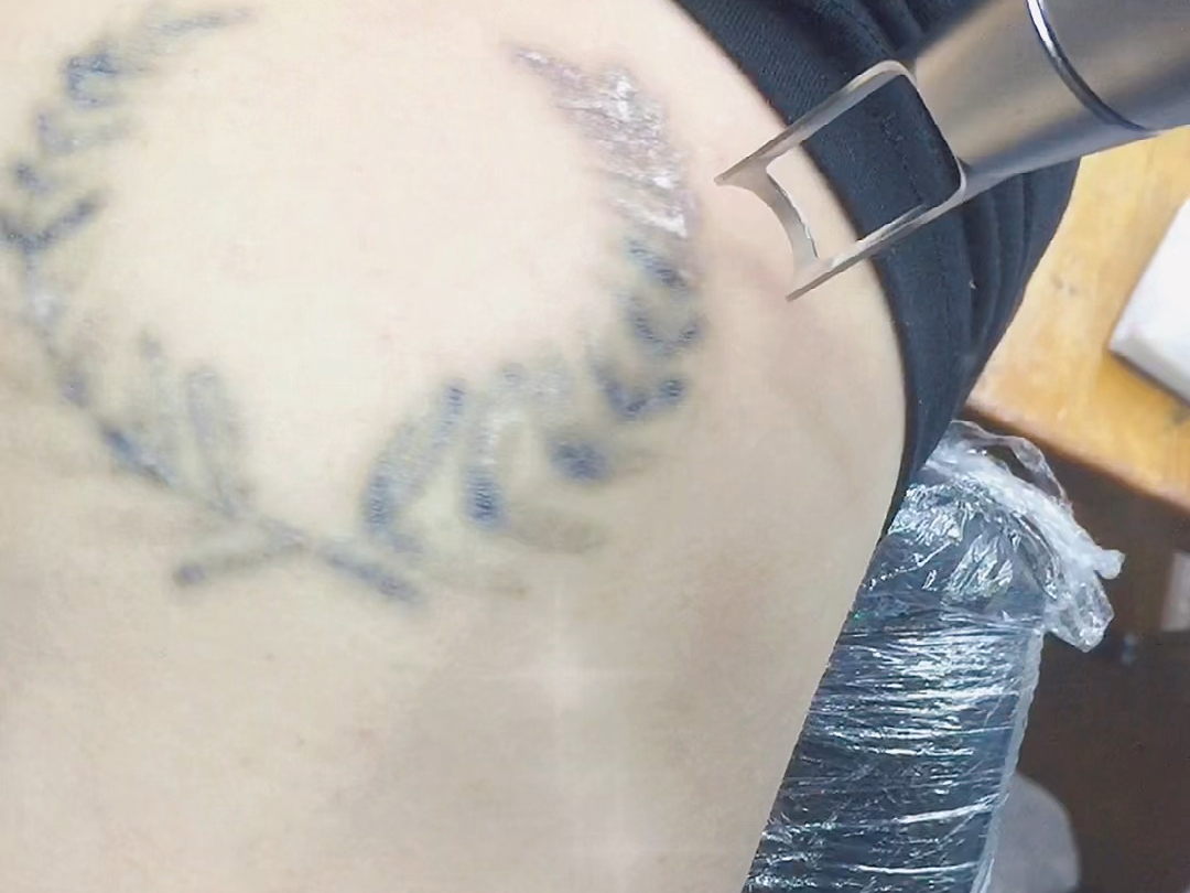 超皮秒激光清洗纹身不留疤