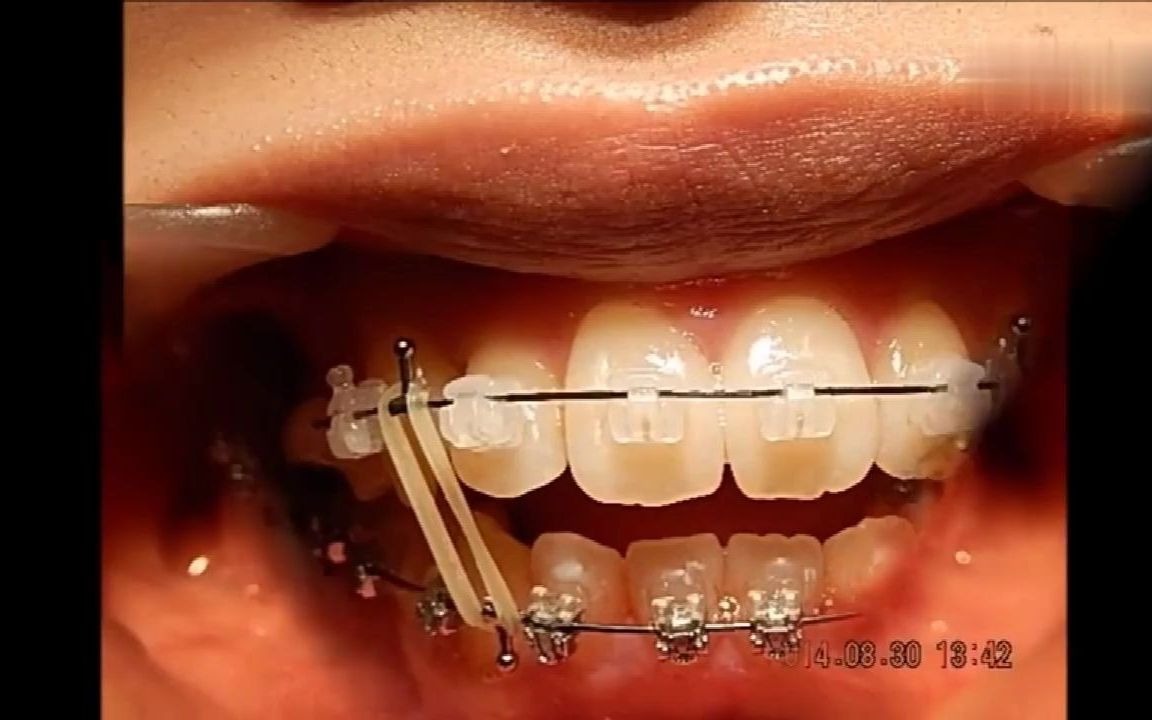 挂橡皮筋改变开颌情况咬合问题一定要及时矫正