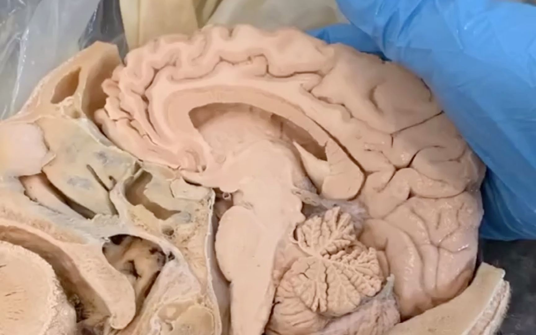 人体标本中枢神经系统脑和脊髓矢状面解剖