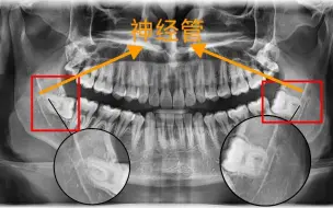 Video herunterladen: 拔完两颗阻生智齿，我想跟大家分享我的经历