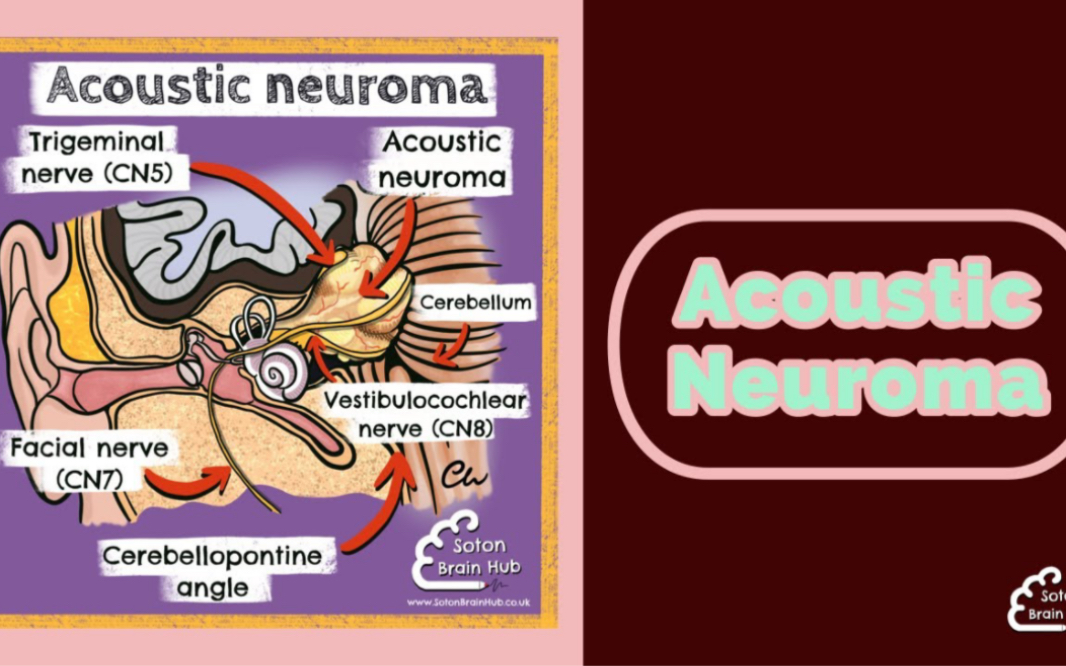 【神经系统解剖学】听神经瘤Acoustic Neuroma|症状 体征 手术治疗|趣味医学|神经系统解剖学哔哩哔哩bilibili